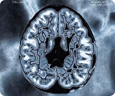 Understanding Chronic Migraines