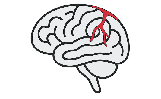 Cranial dural fistula