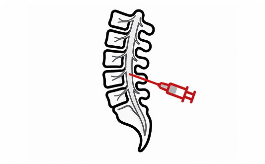 Myelogram