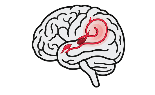 Stroke