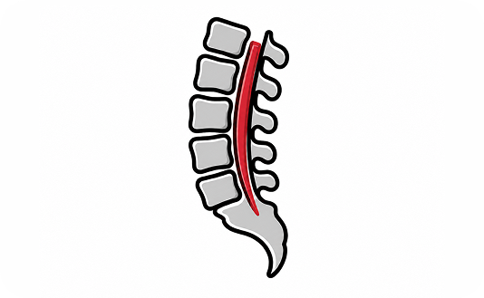 Spinal dural fistula