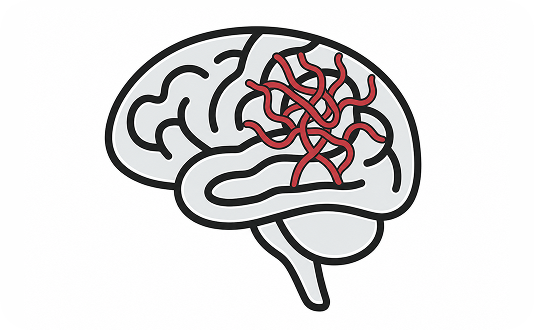 Brain AVM